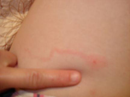 spider-bite-human